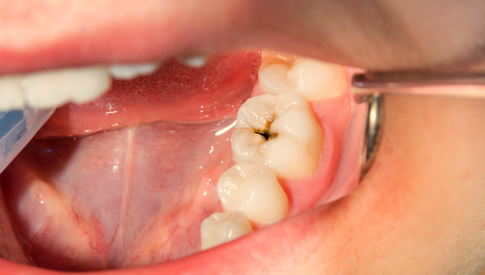caries.jpg